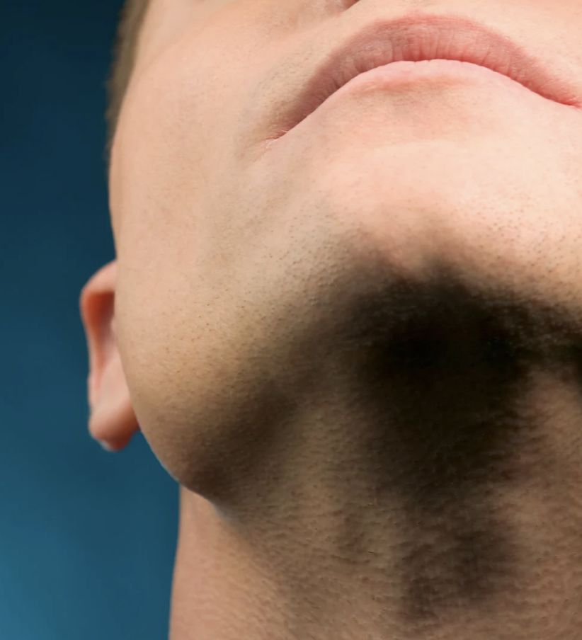 Chin Augmentation